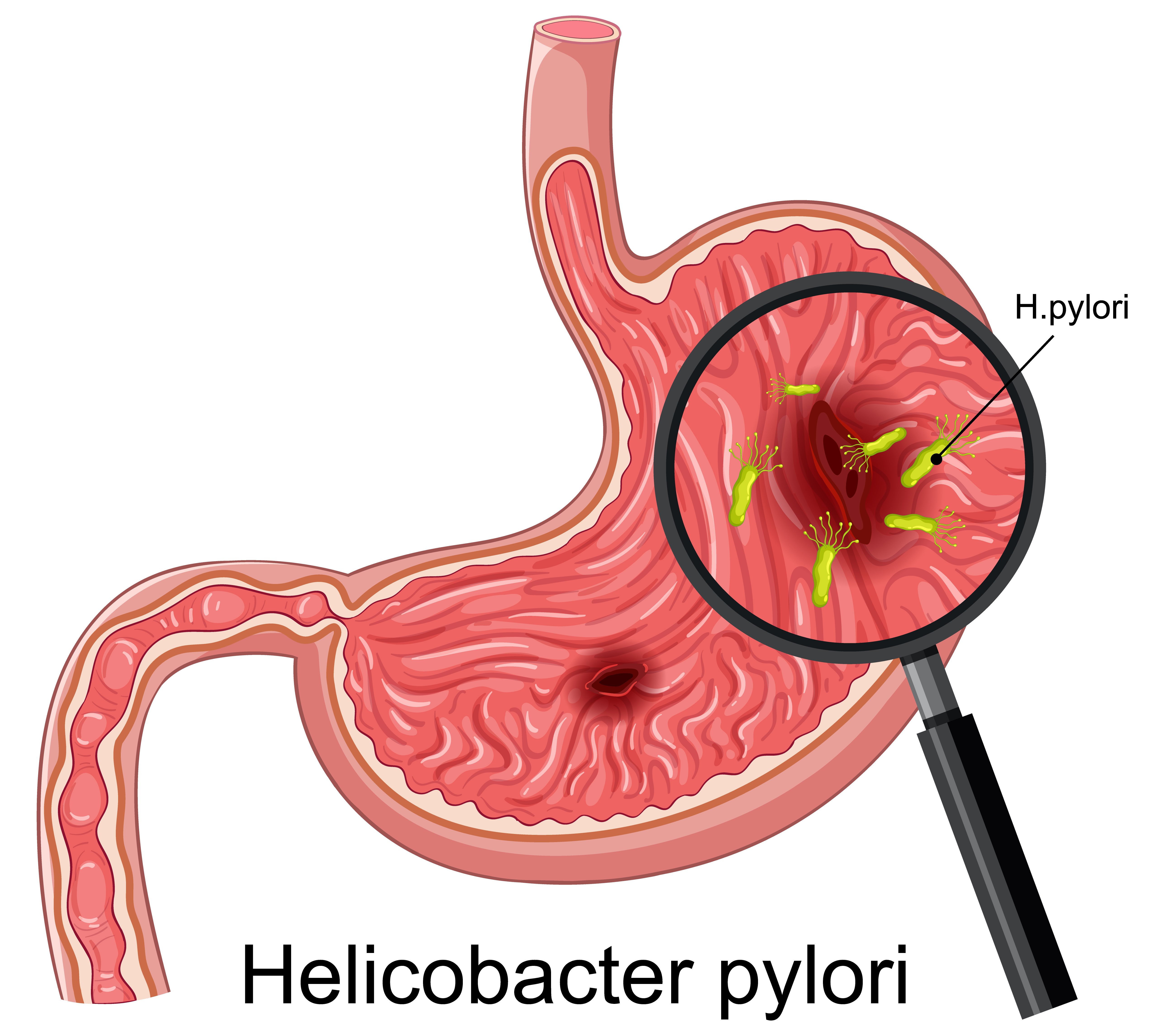 What is Gastric Endoscopy?