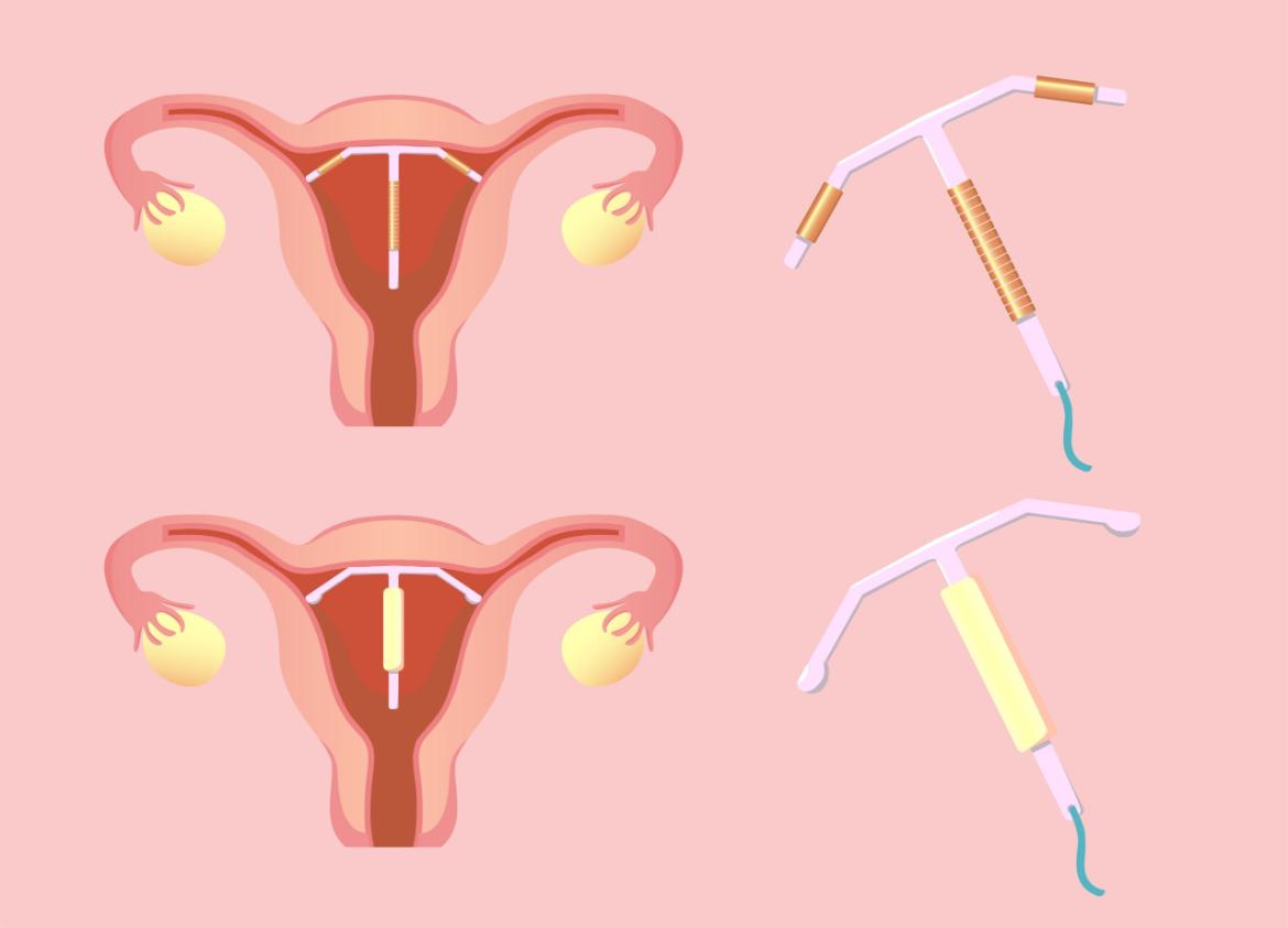 Intrauterine Device: What You Need to Know About the IUD