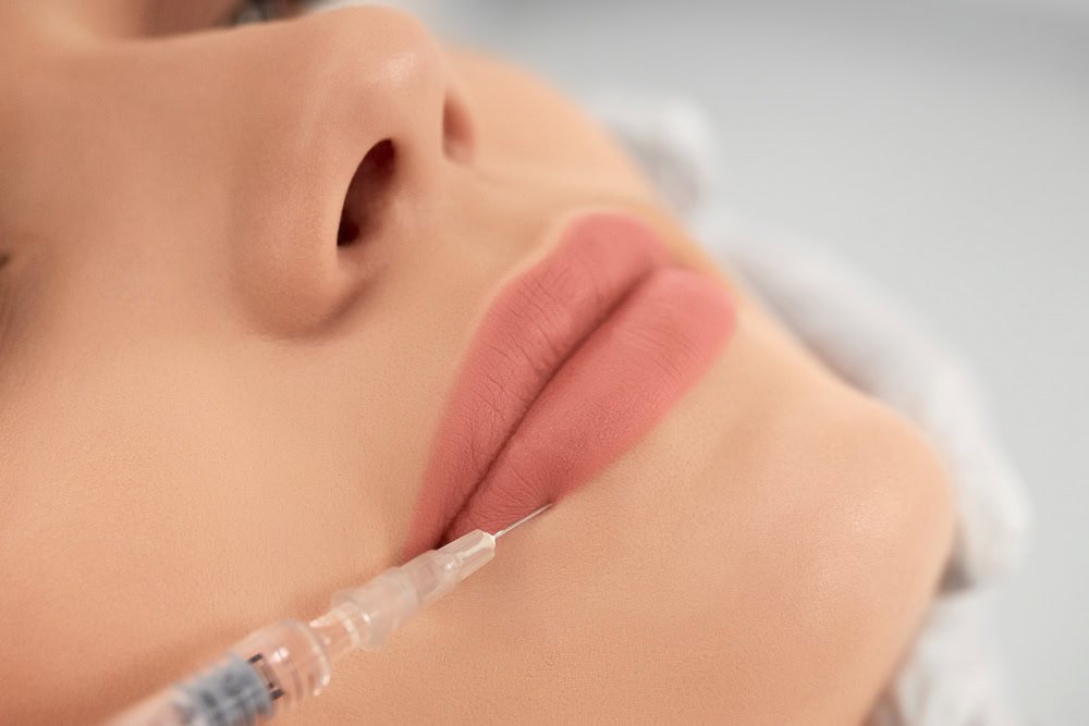 Lip Fillers