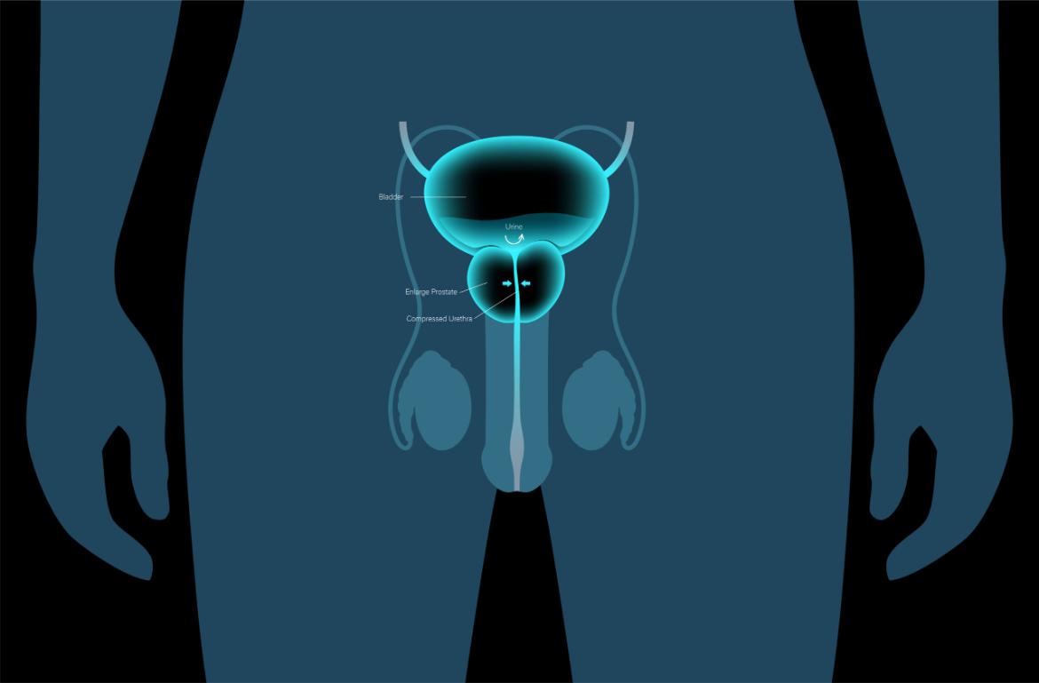 What is Open Prostate Surgery and How is it Performed?