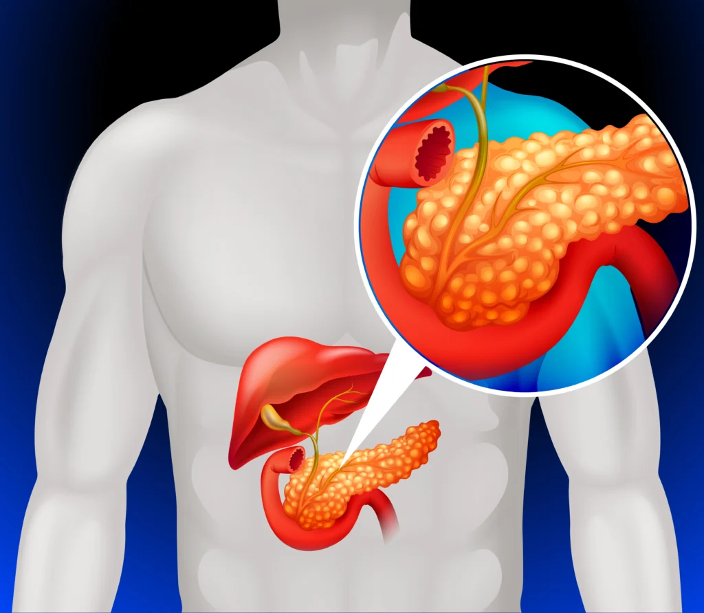 What is acute pancreatitis? Symptoms and treatment