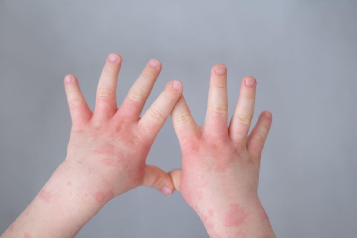 Allergy