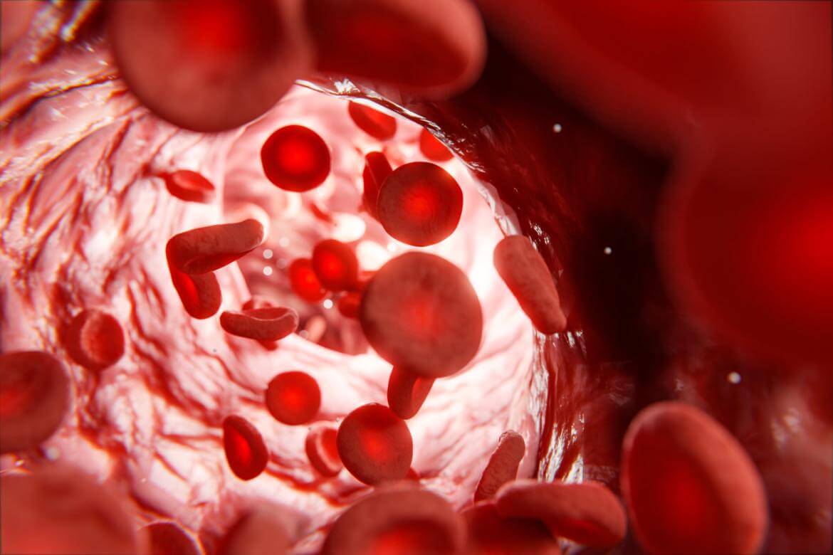 Anemia