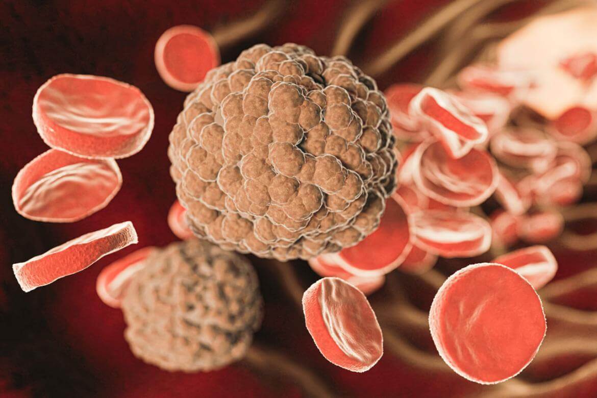 What is Aplastic Anemia? Symptoms and Treatment