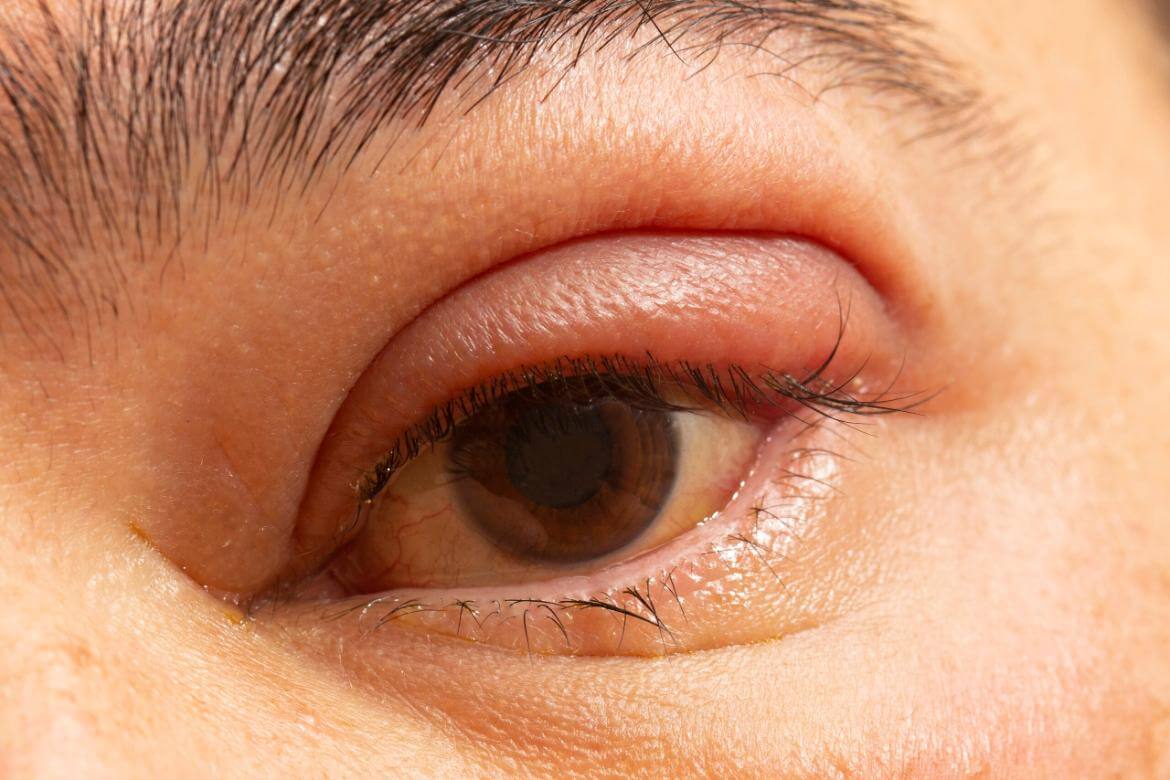 Stye