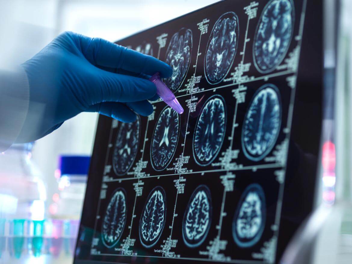 Brain Inflammation (Encephalitis)