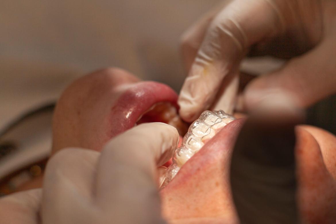 Bruxism – Teeth Clenching