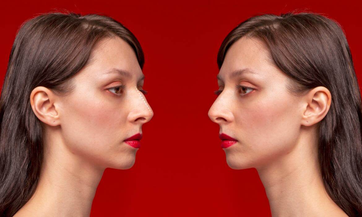 What is Nose Deformity Surgery?