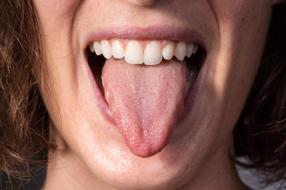 What is macroglossia? How is it treated?