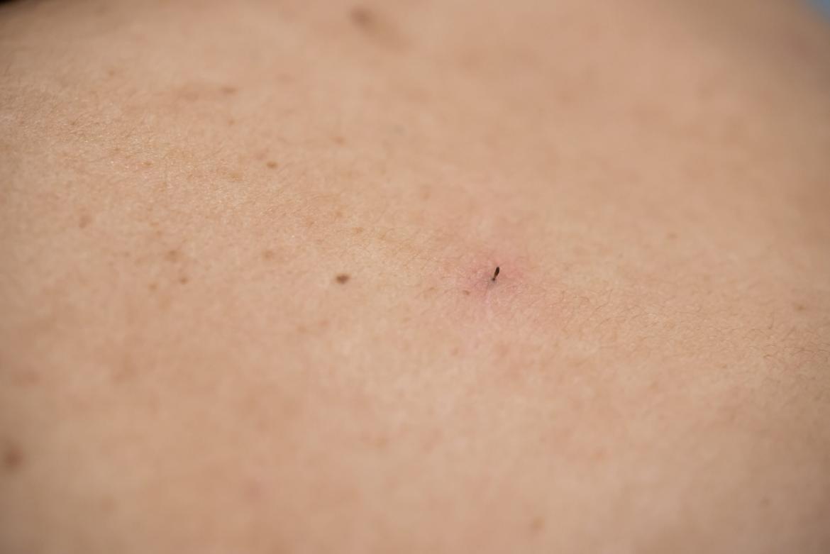 Ingrown Hair Surgery (Pilonidal Sinus)