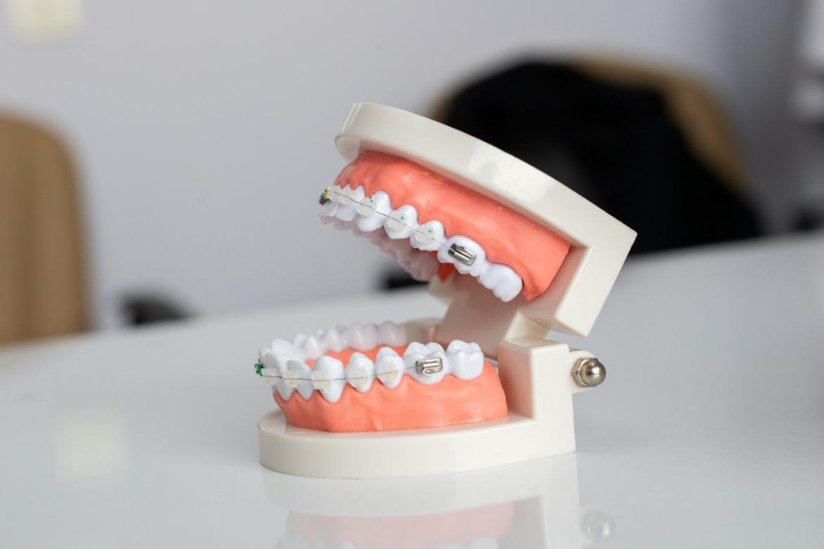 Crooked Teeth (Malocclusion): What is it, Causes, Symptoms, Treatment and Solution Methods