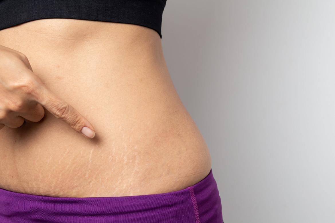 How to Treat Stretch Marks?