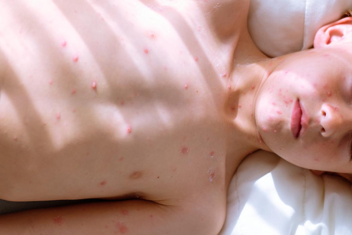 Smallpox