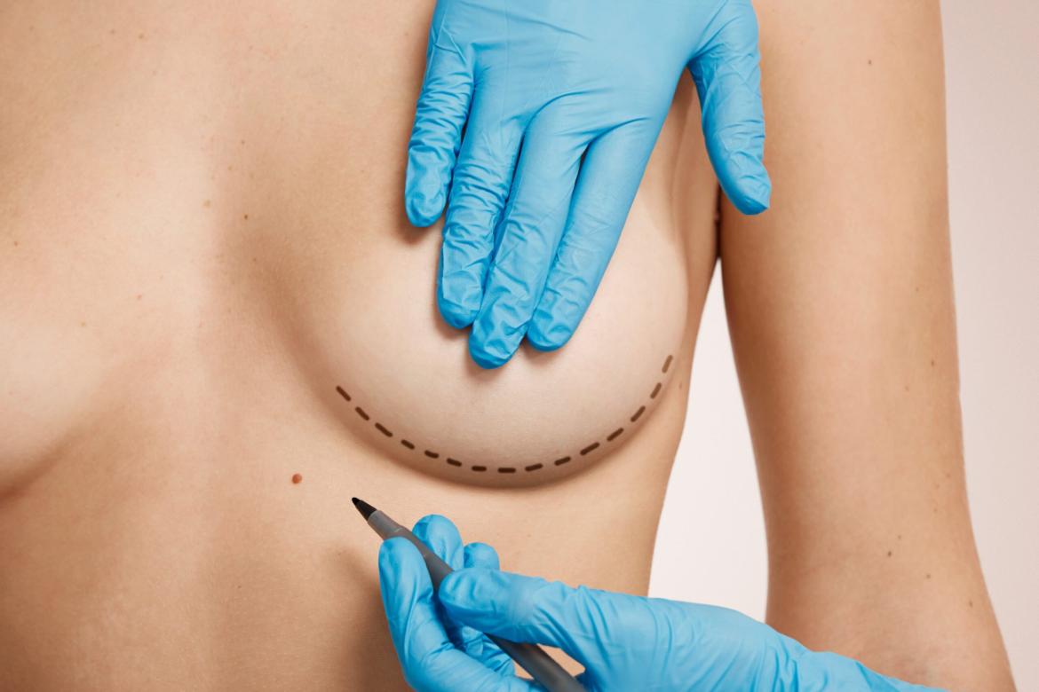Breast Lift Surgery
