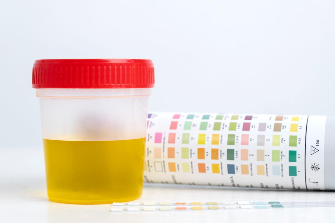 What is Density? Low and High Density in Urine?