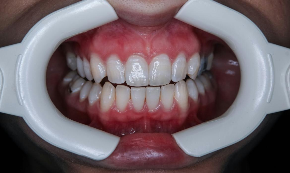 Gum Disease: Symptoms, Causes, Treatment Methods