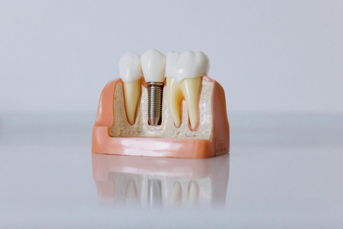 Dental Implants: The Key to Healthy and Lasting Smiles