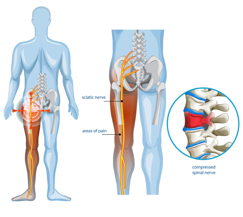 What is Sciatica? (Pain Radiating from the Waist to the Leg)