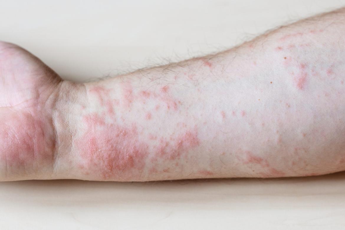 Adult Still's Disease