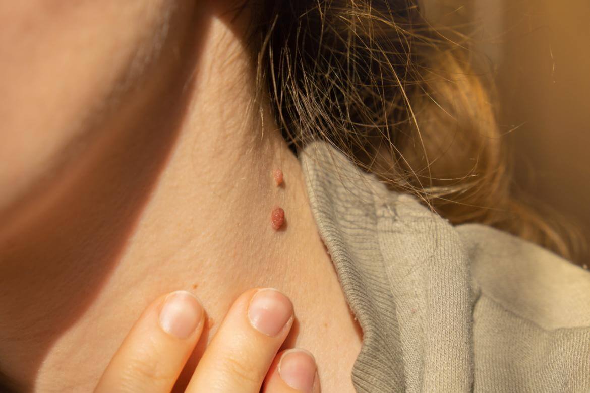 Skin Tags