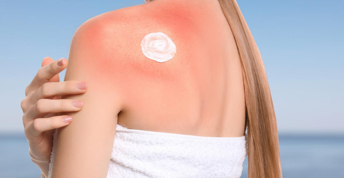 Sun Allergy
