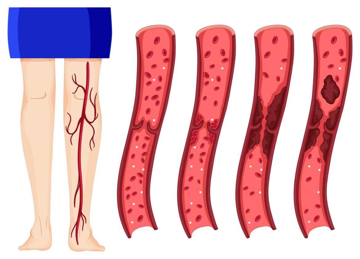 Hematoma