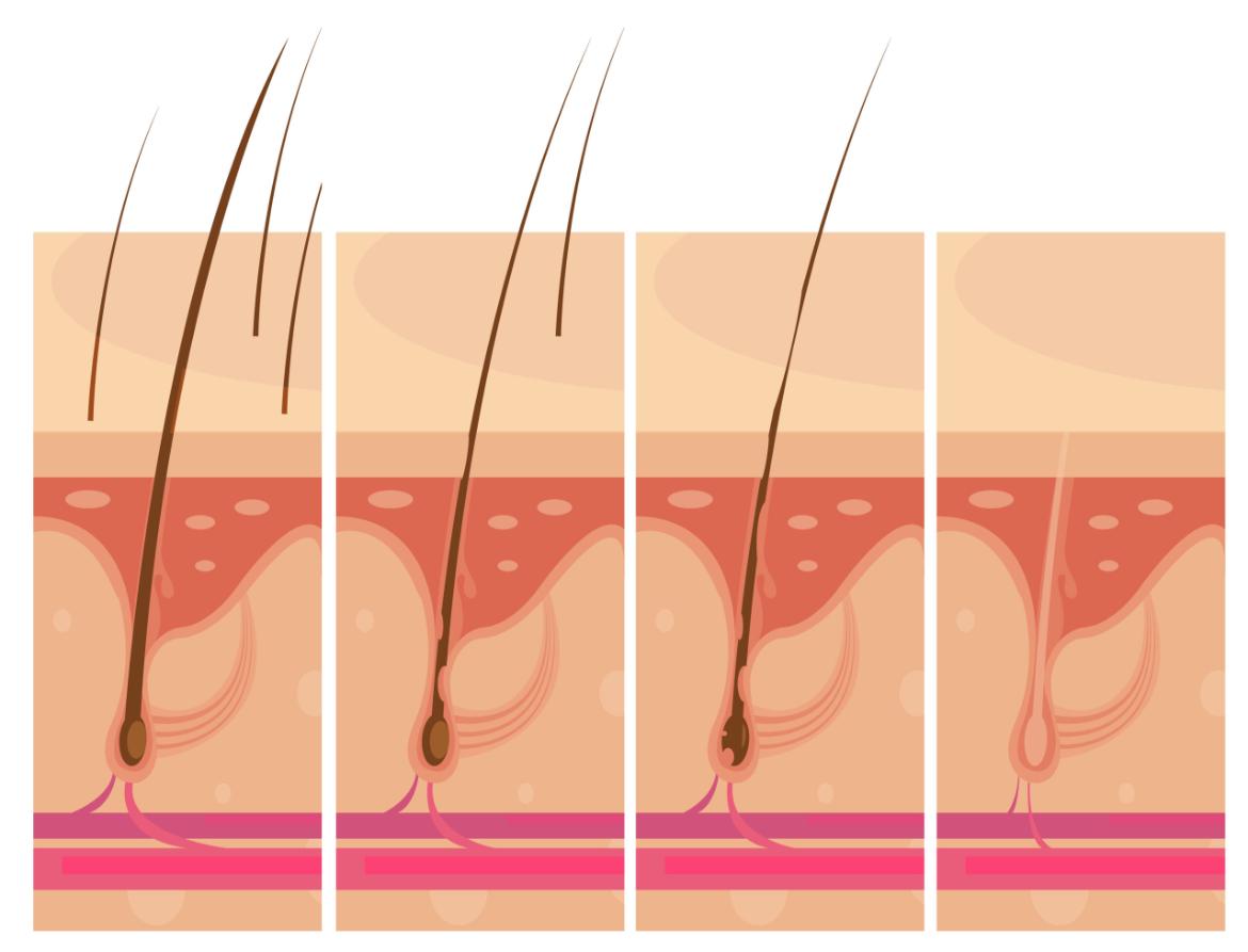 Hirsutism (Excessive Hair Growth)