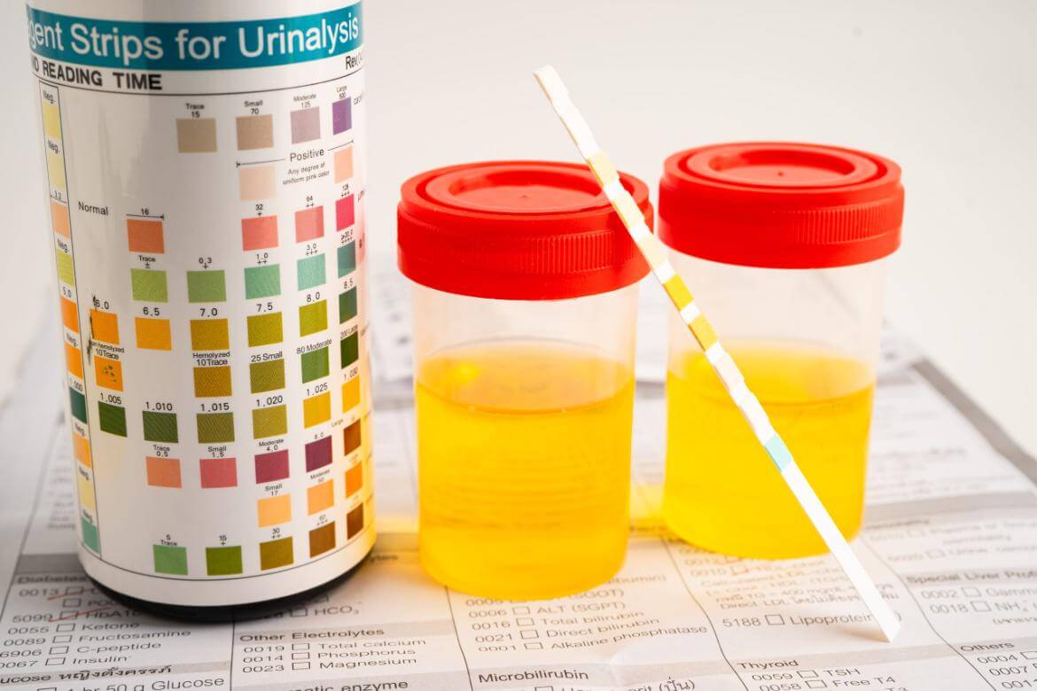 Urinalysis