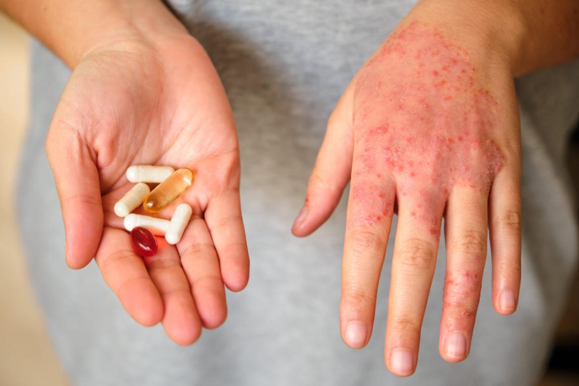 Symptoms and Treatment Options for Drug Allergy