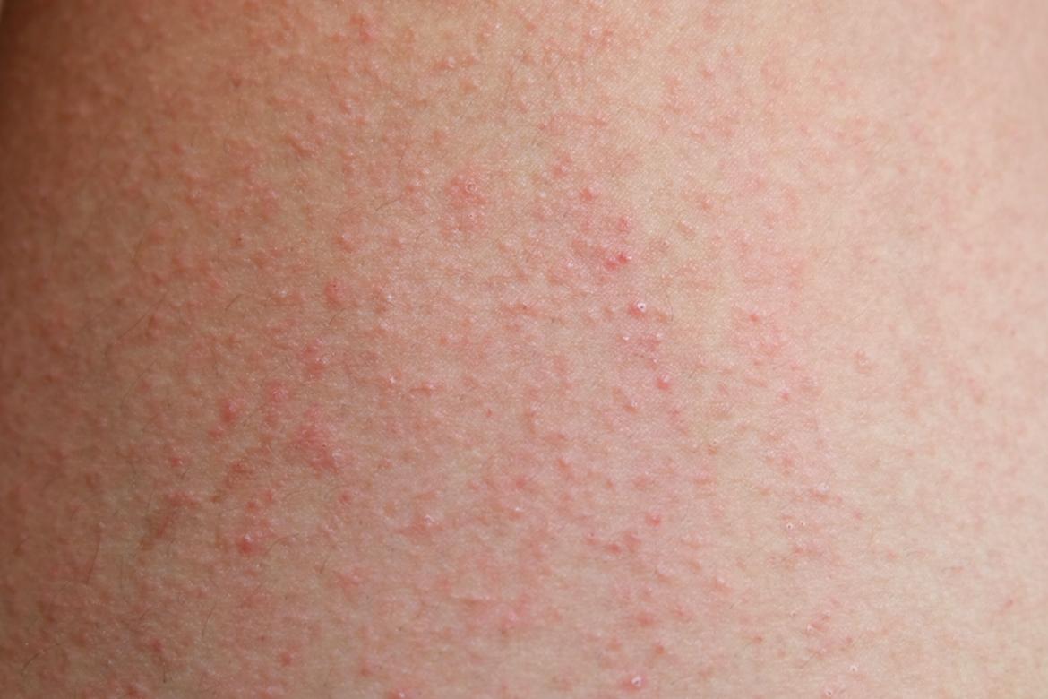 Rash