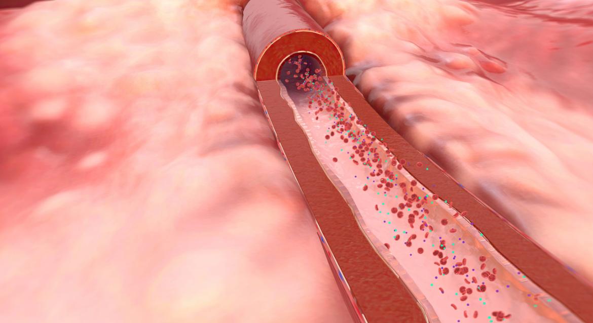 What is Ischemia? Symptoms and Treatment Methods