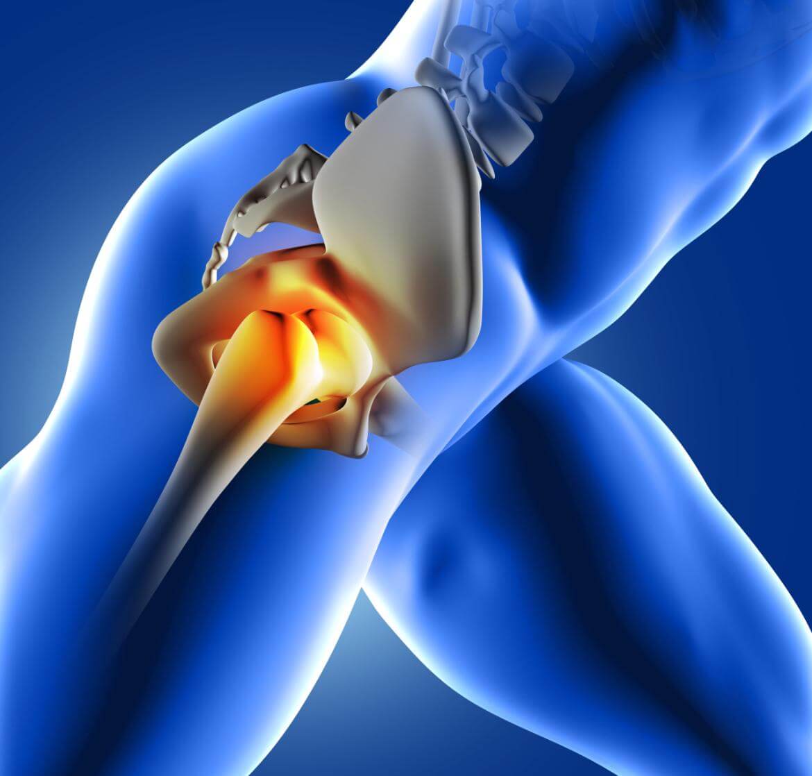 What is Hip Dislocation?