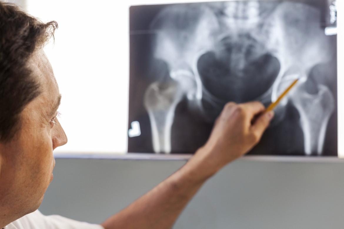 The 3 Main Symptoms of Hip Arthritis