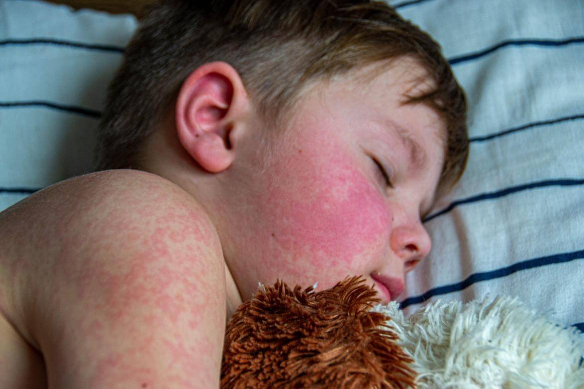 Kawasaki Disease