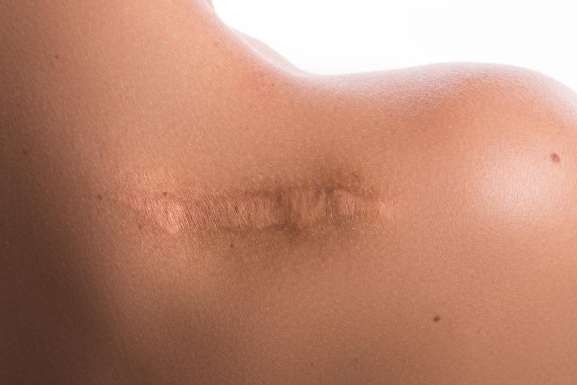 Keloid