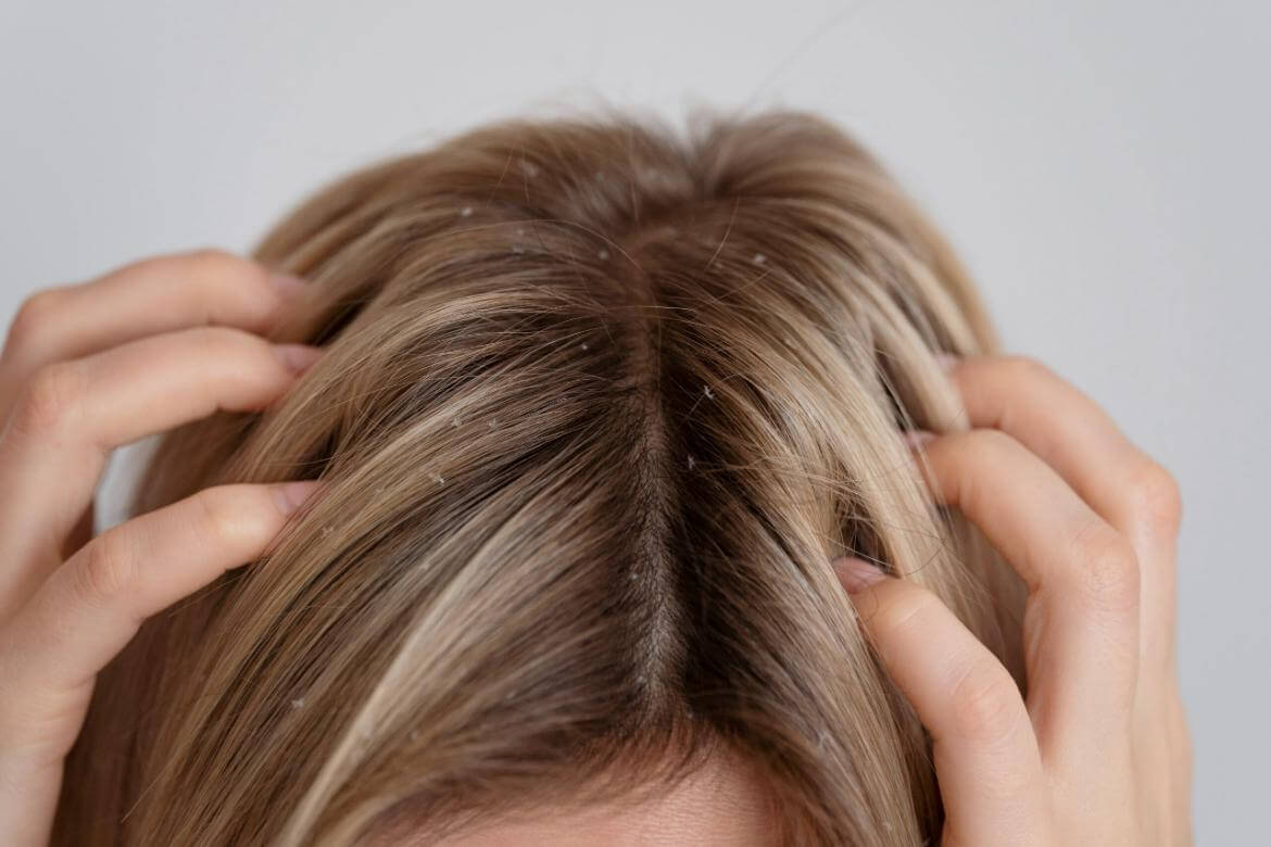 What is Dandruff? What Causes It and How Can It Be Prevented?