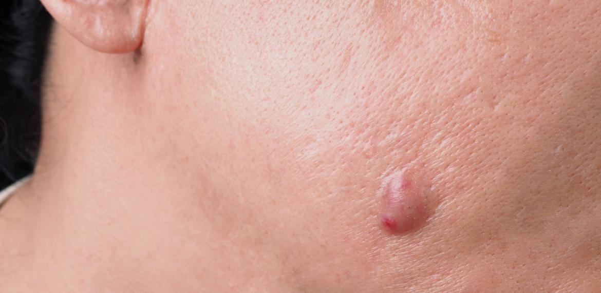 Ingrown Hair (Pilonidal Sinus)
