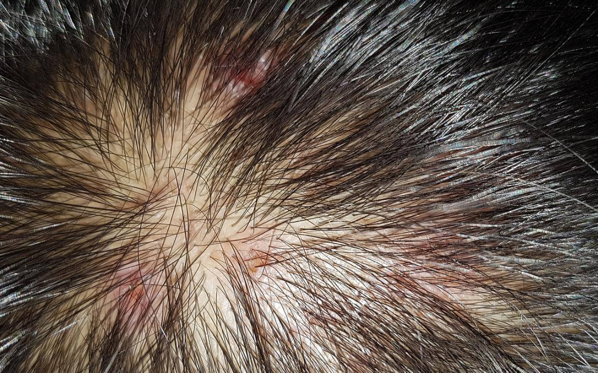 Hair Follicle Inflammation (Folliculitis)