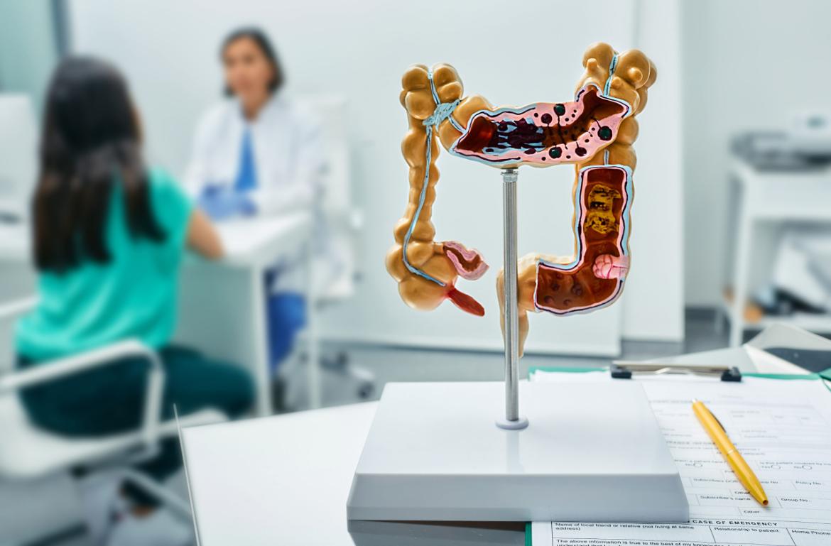 What is Colon Cancer (Large Intestine Cancer)?