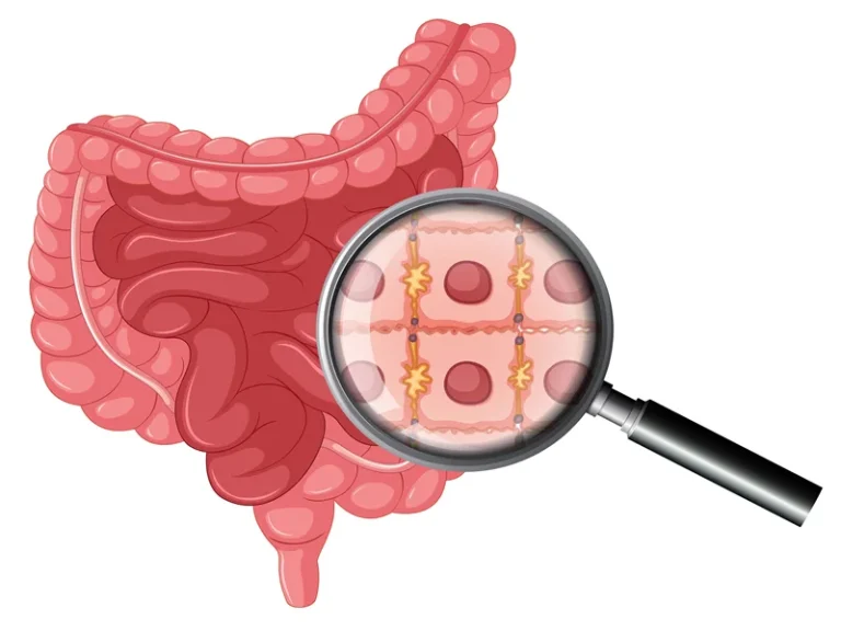 What is a Colostomy?