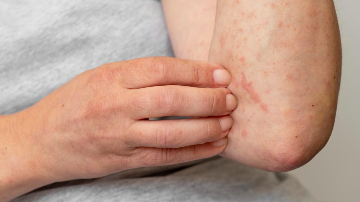 Hives (Urticaria)
