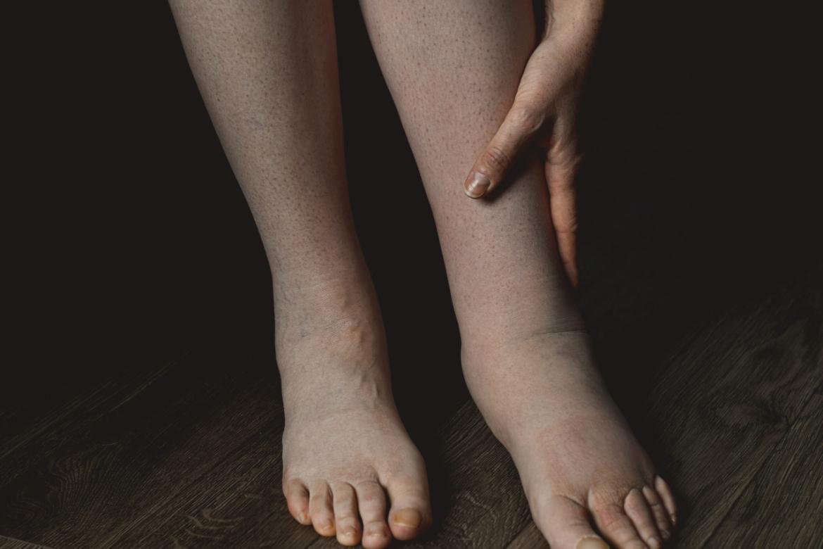 Lymphedema (Elephantiasis)