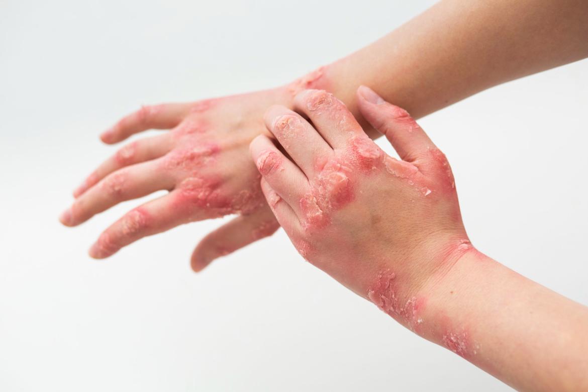Lichen Planus