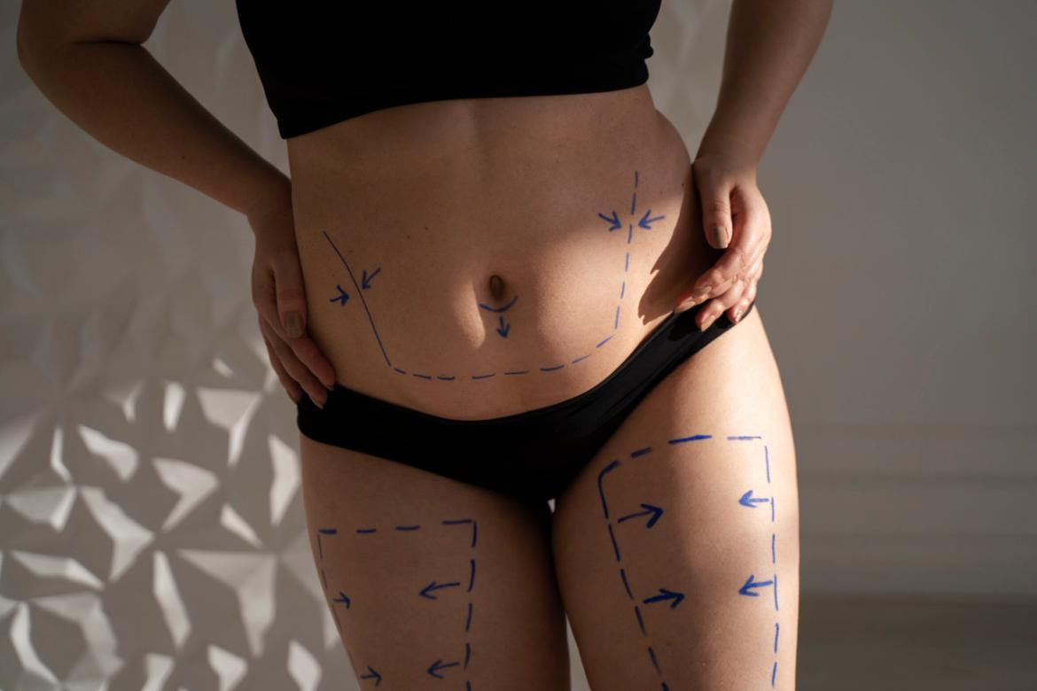 Liposuction (Fat Removal) Surgery