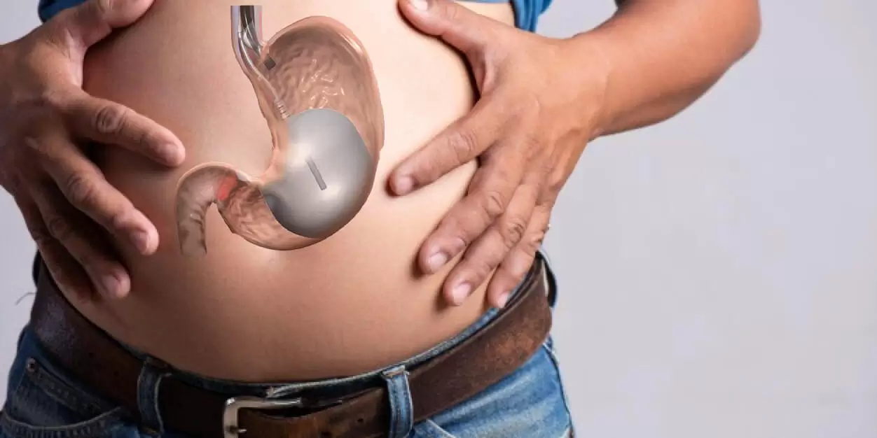 Gastric Balloon Guide 2025