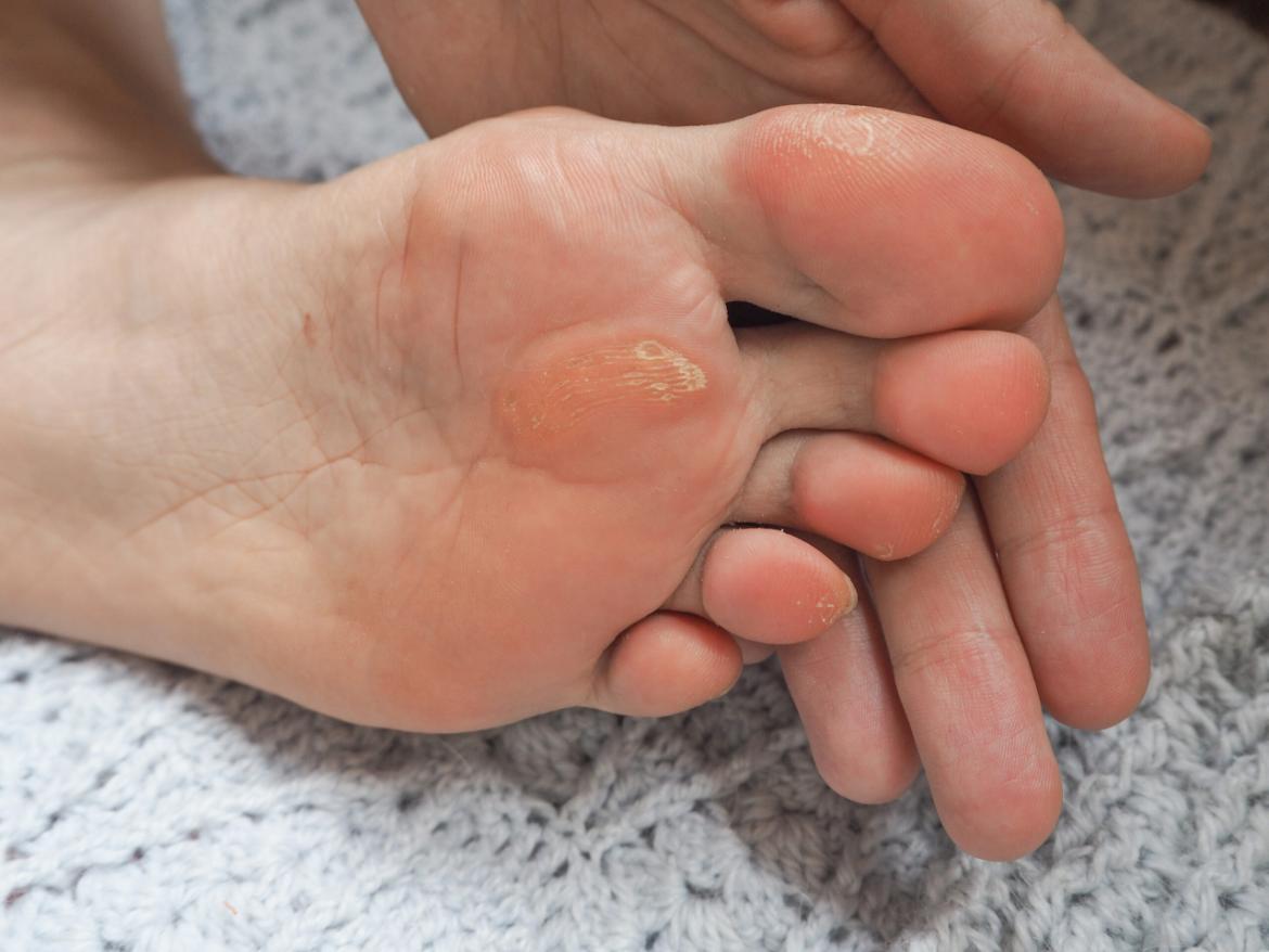 What is a Callus? What is Good for a Callus?