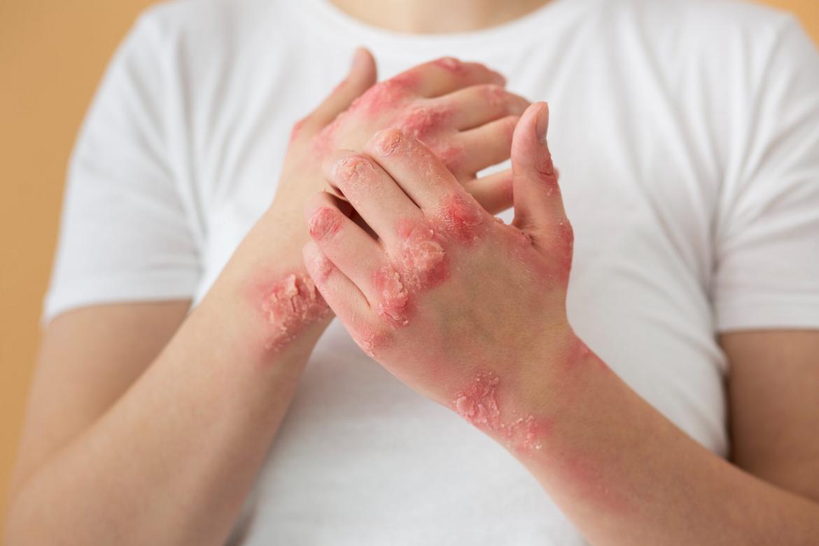 What is pemphigus? Pemphigus symptoms and treatment options