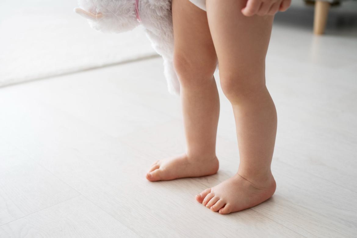 Perthes Disease