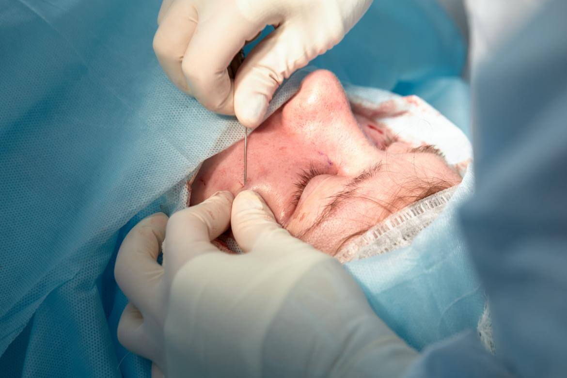 Pilonidal Sinus