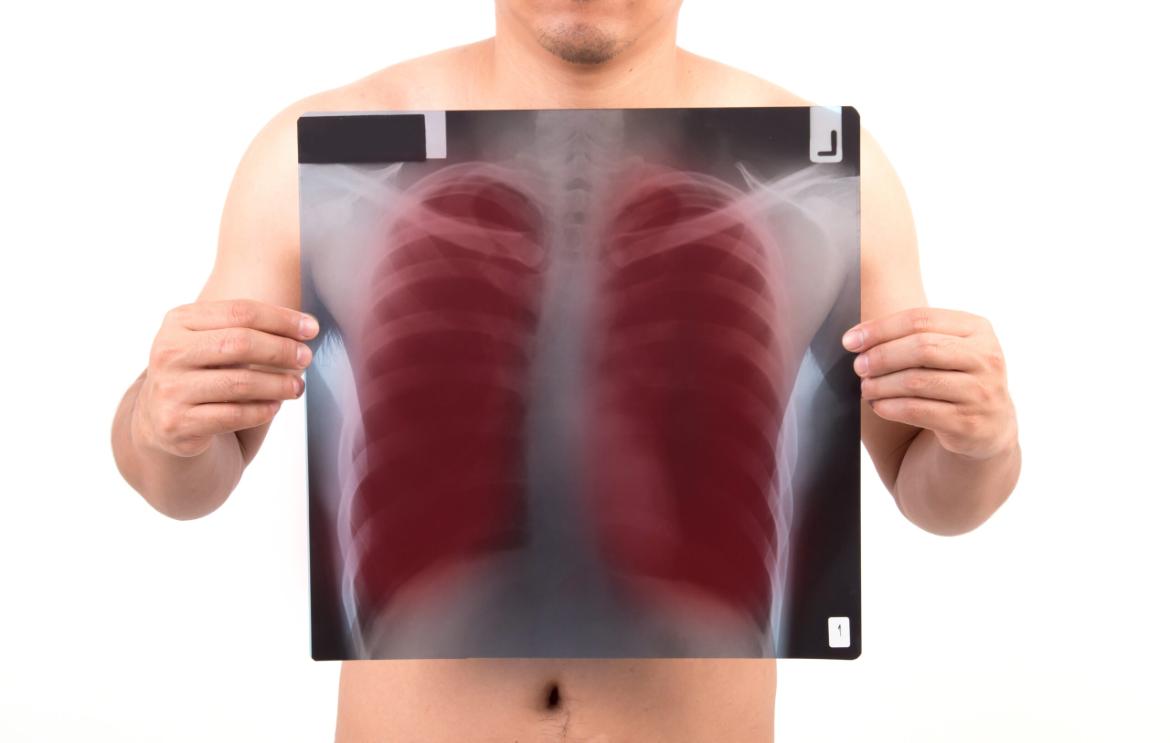 Pleurisy